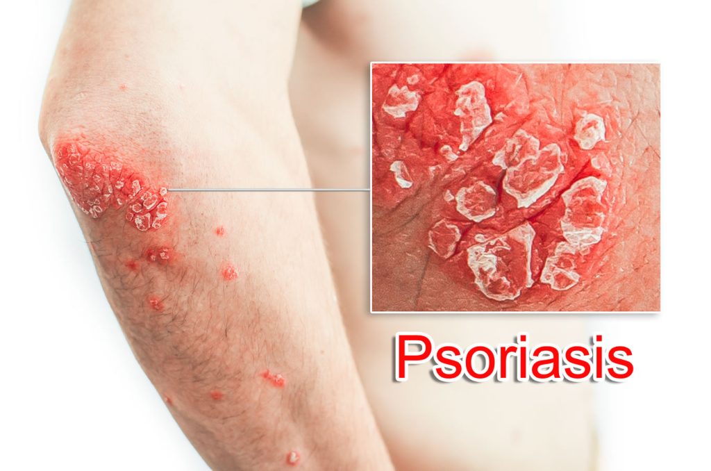 Psorijaza